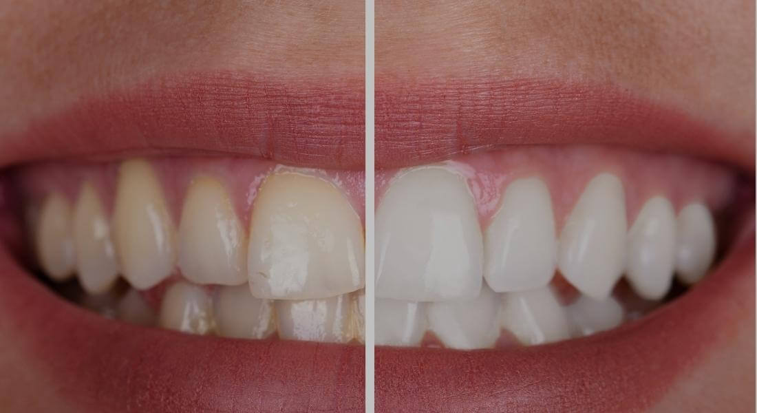 Tips to get maximum teeth whitening