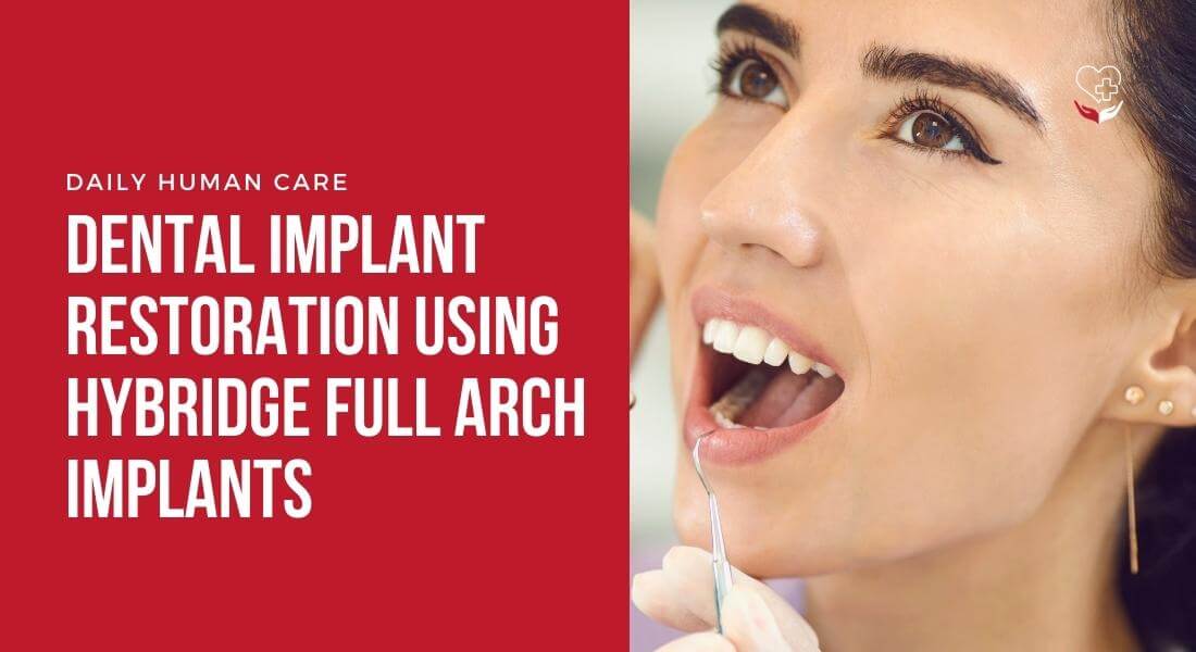 Dental Implant Restoration Using Hybridge Full Arch Implants